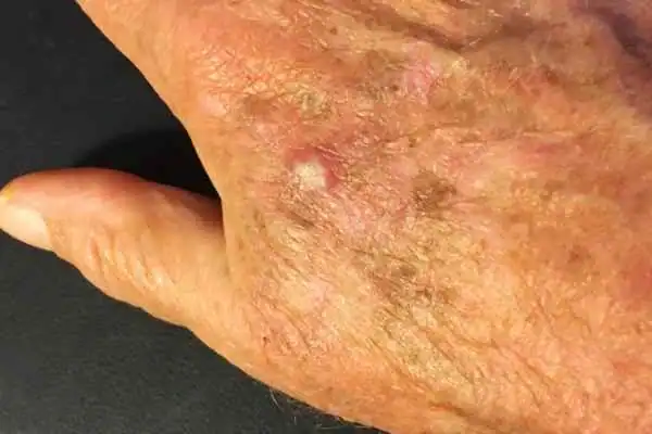Cryopen For Actinic Keratoses 1 Image of Actinic keratoses Hove on a person hand
