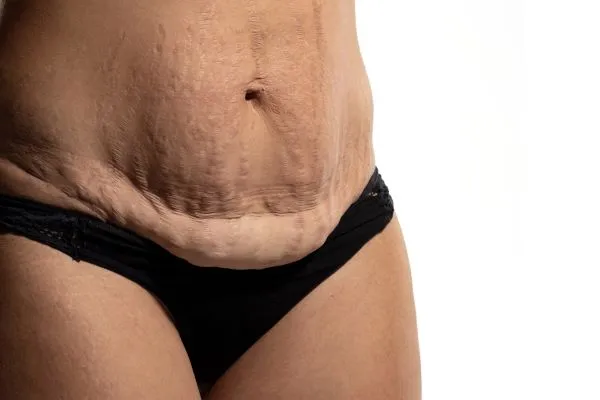 The science behind skin tightening Hove picture of a woman's sagging skin on the stomach